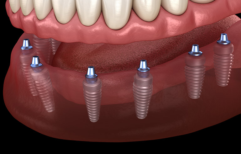 découvrez comment la couverture maladie universelle (cmu) peut vous aider à financer vos implants dentaires. informez-vous sur les droits, les démarches à suivre et les solutions pour bénéficier de soins dentaires adaptés à vos besoins.