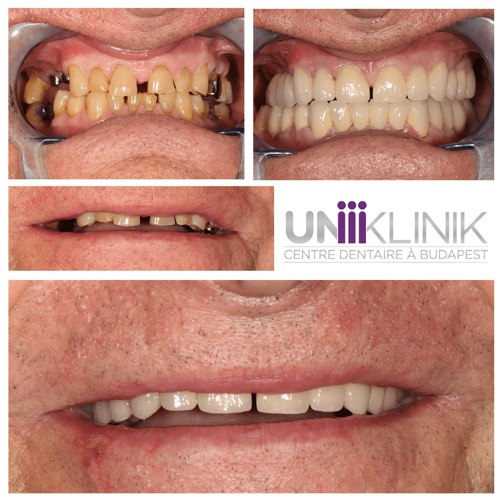 découvrez notre service de détartrage remboursé, conçu pour prendre soin de votre santé bucco-dentaire sans frais supplémentaires. profitez d'une bouche saine et fraîche tout en bénéficiant d'une prise en charge complète par votre mutuelle.